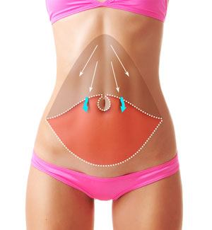 Abdominoplasty