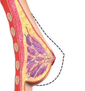 Breast Reduction