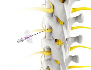 Epidural Steriod Injections