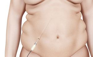 Reverse Tummy Tuck  Houston Plastic and Reconstructive Surgery