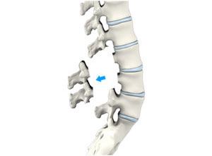 Lumbar Laminectomy