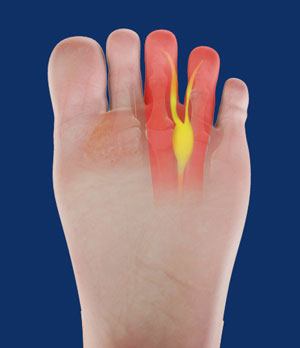 Mortons Neuroma