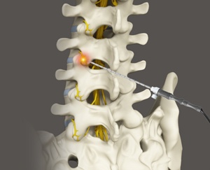Epidural Steriod Injections