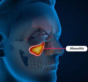 Sinus Cases