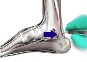 Tarsal Tunnel Release